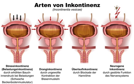 Grafik zu den Arten der Inkontinenz