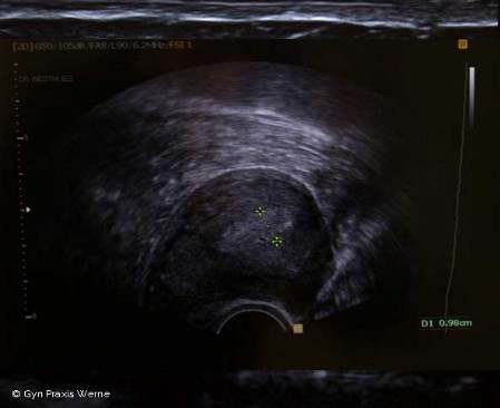 Ultraschallbild kleines Becken Gyn Werne